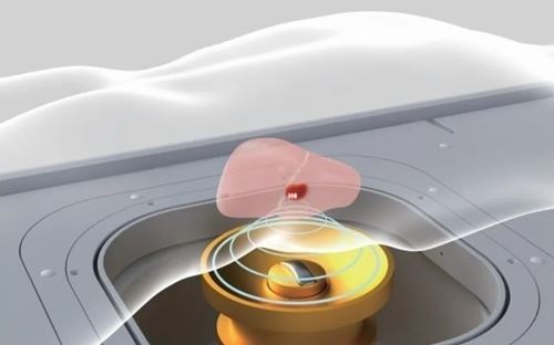 关爱健康,无创守护 | 苏州名仕医院“高强度超声聚焦无创治疗"筛查活动开启(图3) 关爱健康,无创守护 | 苏州名仕医院“高强度超声聚焦无创治疗"筛查活动开启(图3)